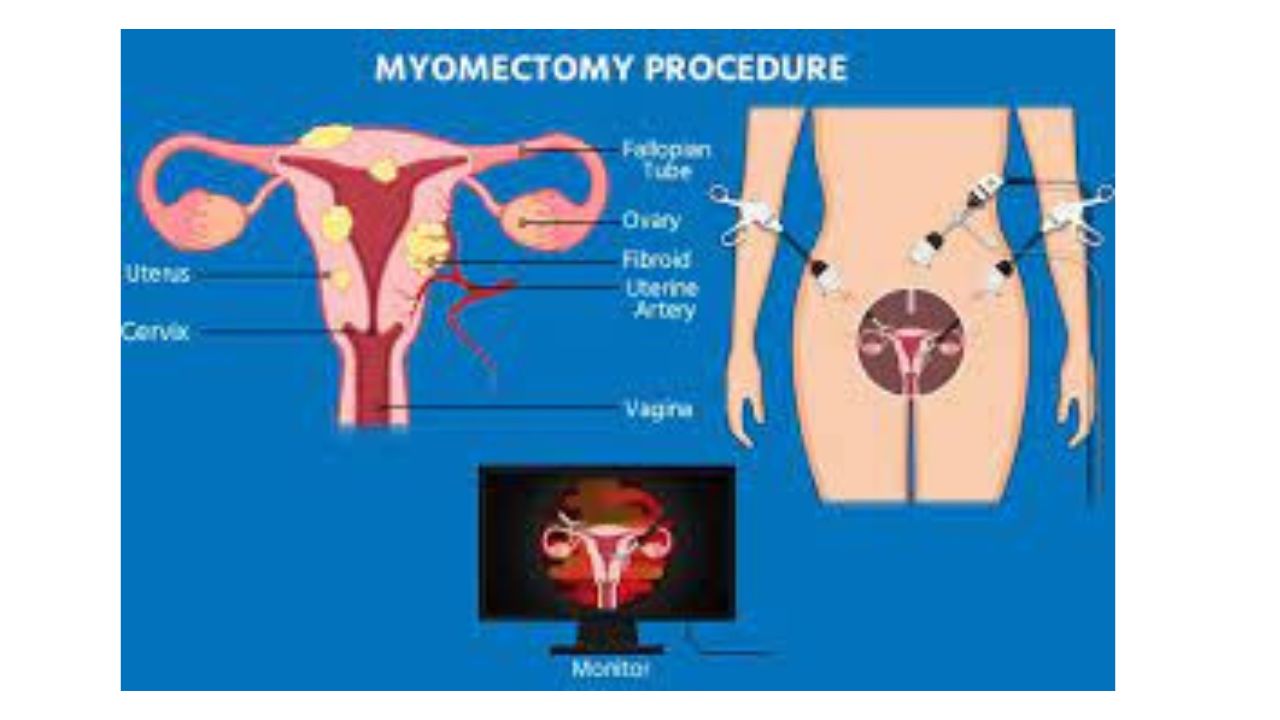 Myomectomy Treatment