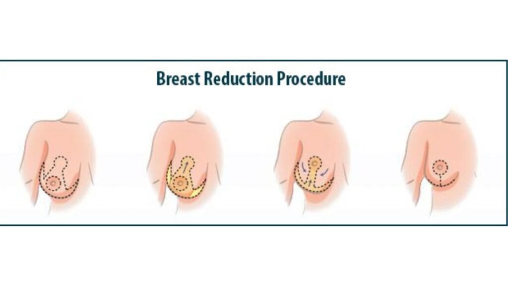 Breast Reduction Surgery