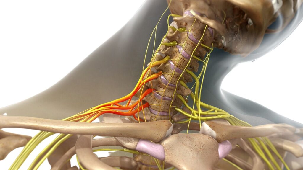 Brachial Plexus Injuries