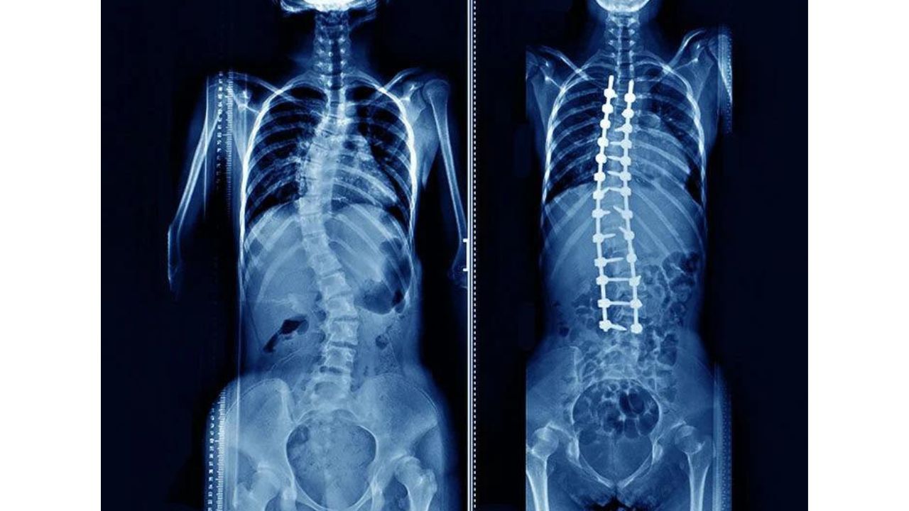 Scoliosis Spine Surgery