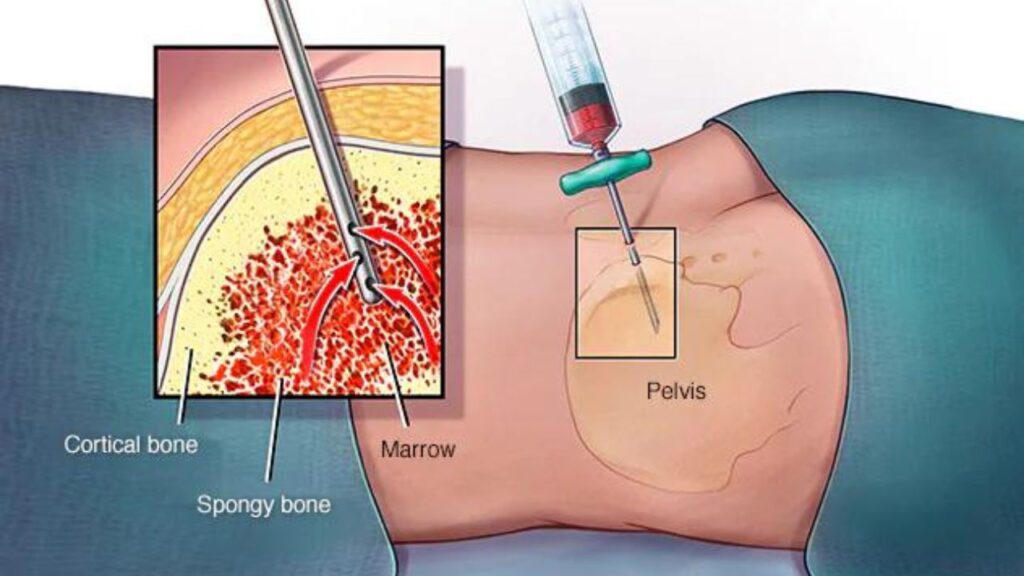 Leukemia Treatment