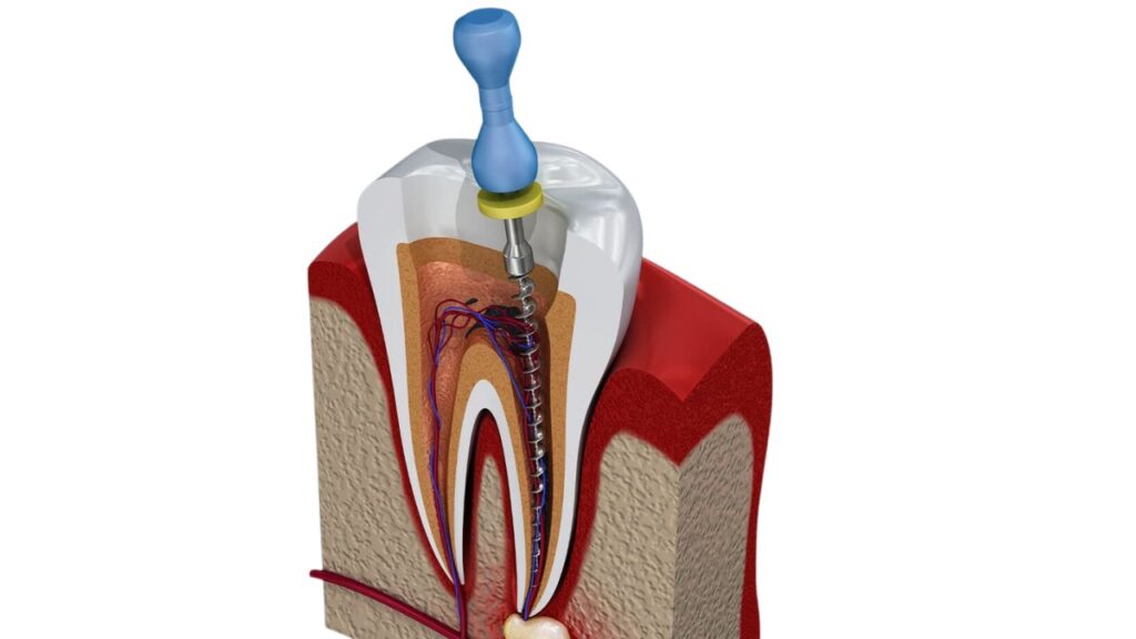 Root Canal Treatment