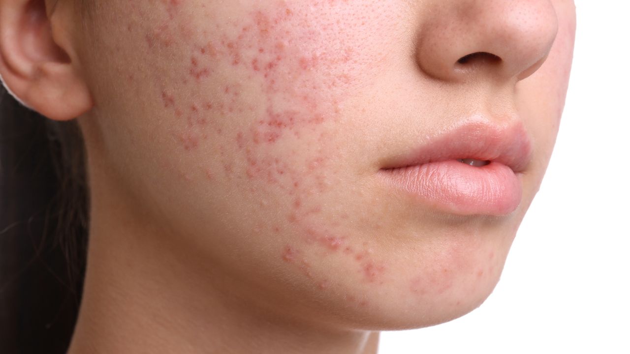 Acne Treatment in India