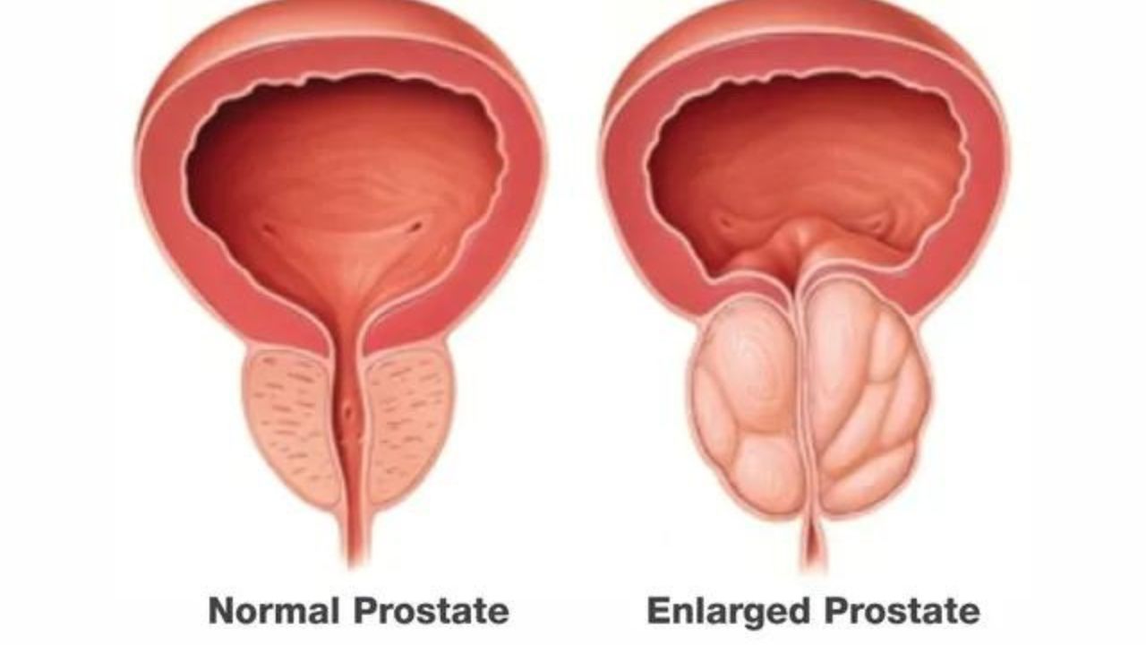 Enlarged Prostate Surgery