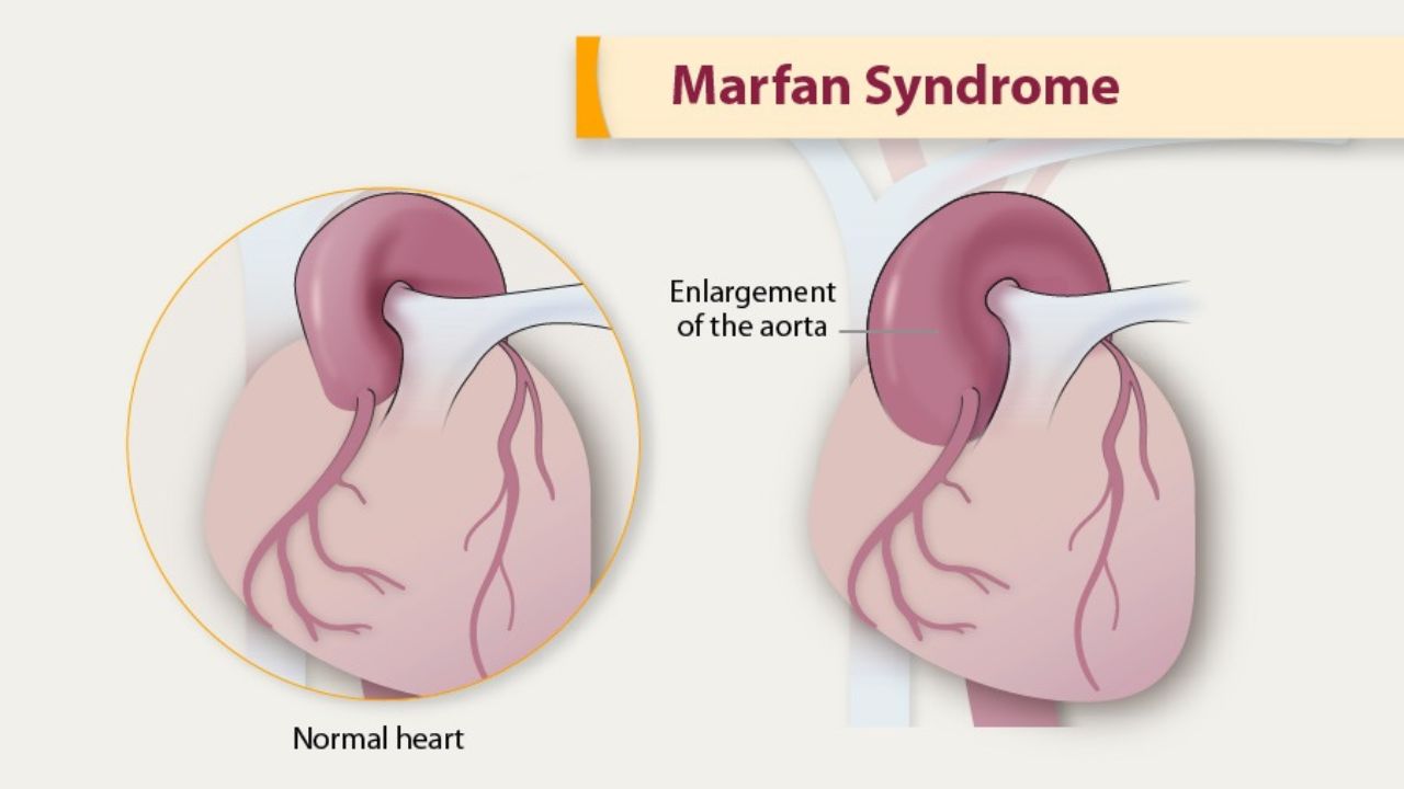 Marfan Syndrome Treatment