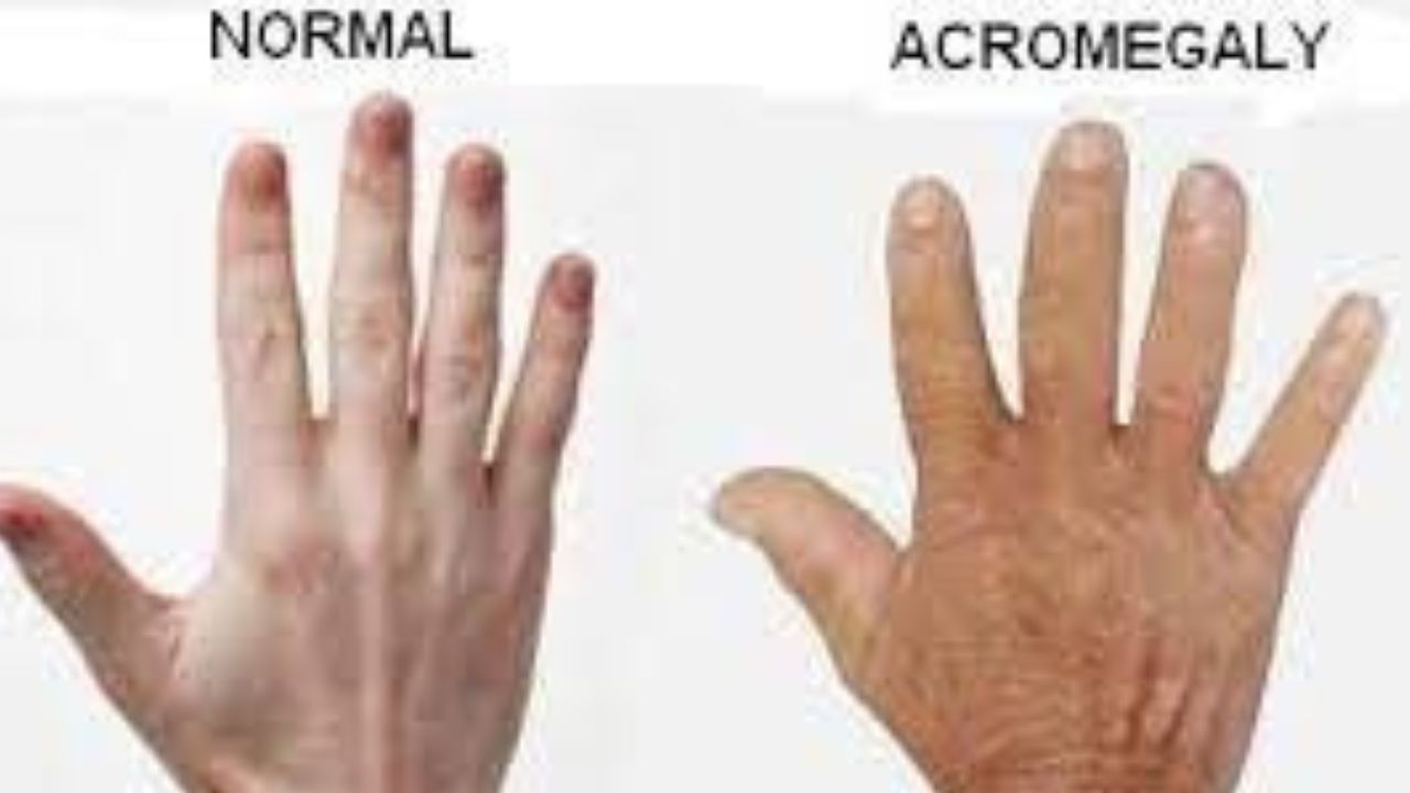 Acromegaly Treatment In India