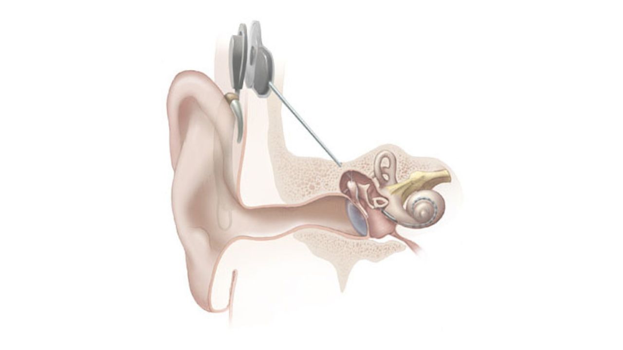 Cochlear Implants Treatment