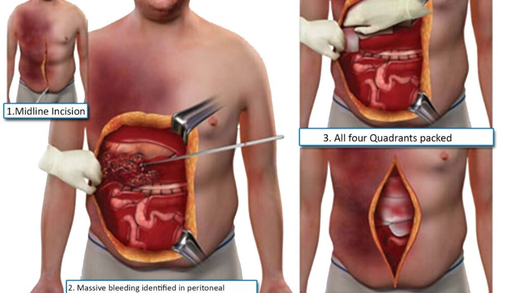 Abdominal Surgery In India