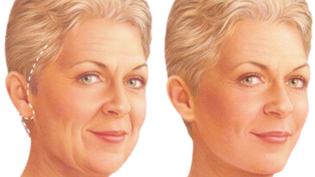 Facelift Surgery In India
