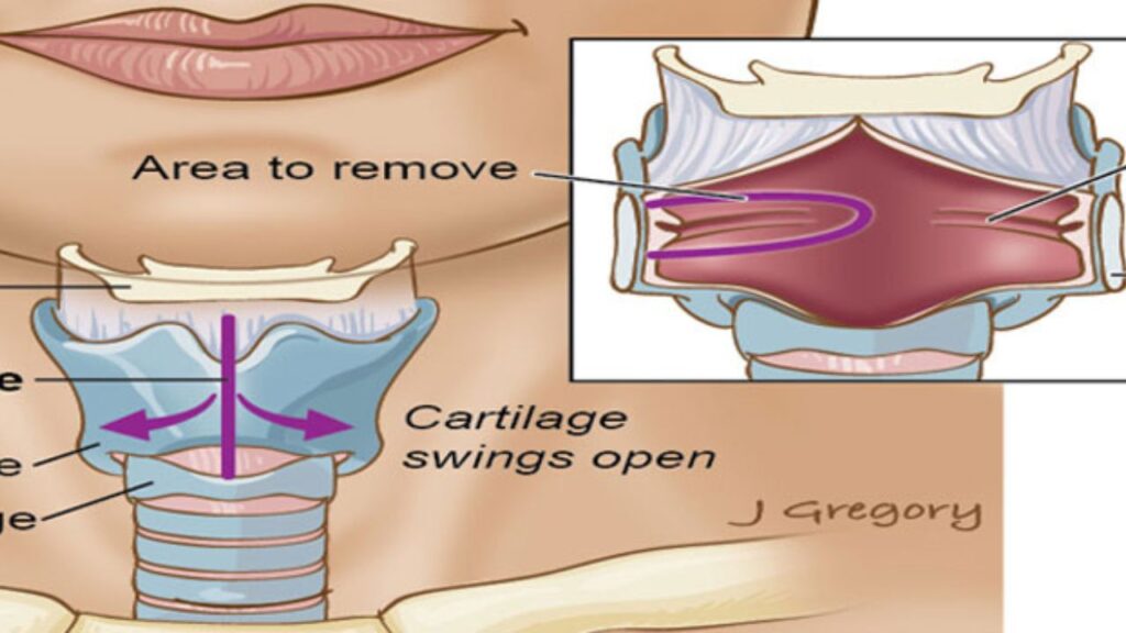 Thyroplasty Surgery In India