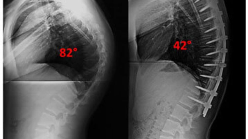 Kyphosis Surgery In India