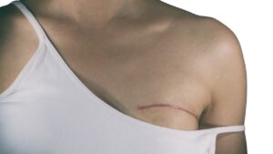 Mastectomy Surgery