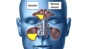 Functional Endoscopic Sinus Surgery