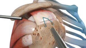 Rotator Cuff Repair surgery