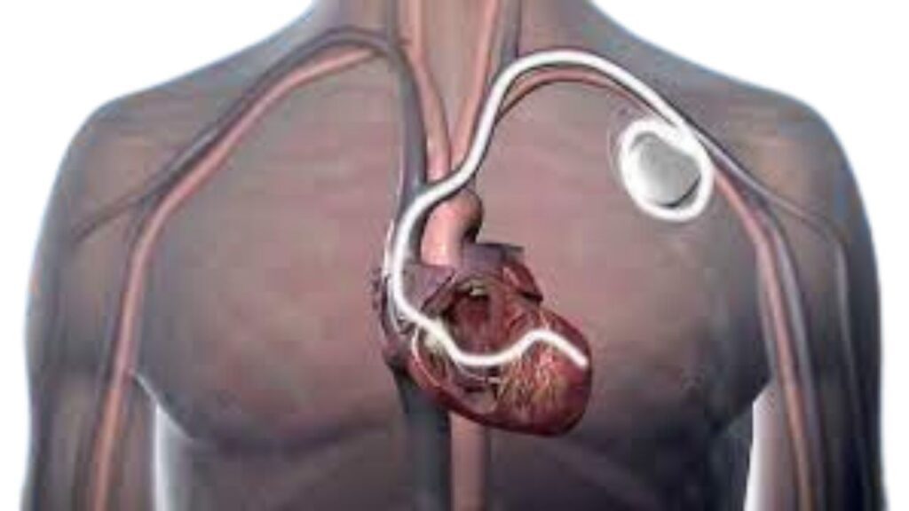 Crt D Implant Cardiac Resynchronization