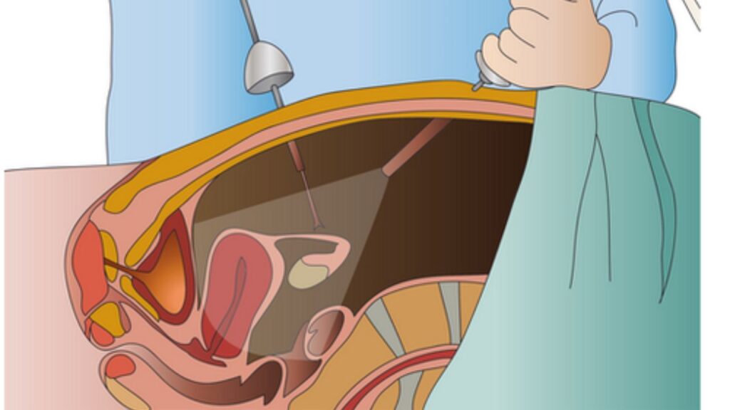 Laparoscopic Urologic Surgery