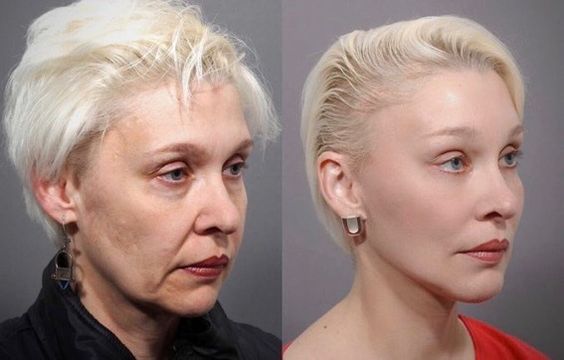 Facelift Surgery In India