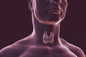 Thyroidectomy Surgery