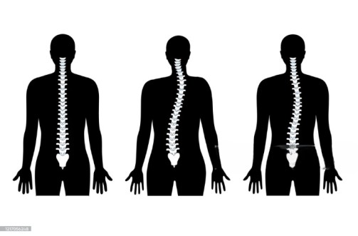 Kyphosis Surgery In India