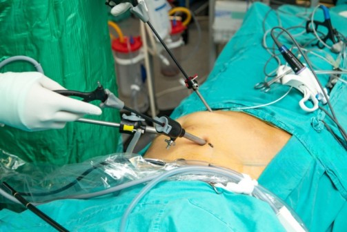 HIPEC Surgery