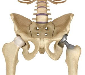 Bilateral Hip Replacement Surgery