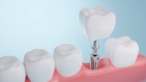 Cost of dental implants in India?