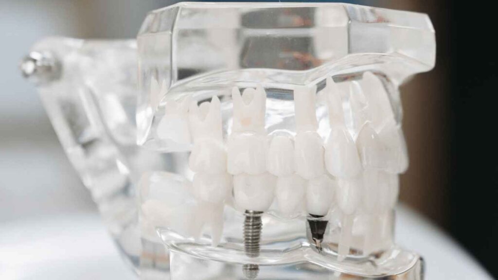 Multiple Teeth Dental Implants India