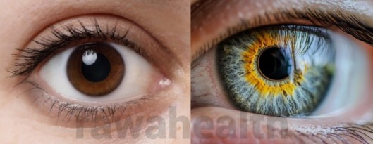 Keratopigmentation Cost in India