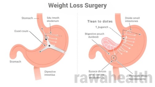 Weight Loss Surgery in India