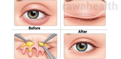 Eye Bag Removal in India