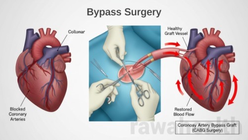 Bypass Surgery (CABG) in India