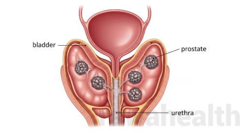 Prostate Surgery in India