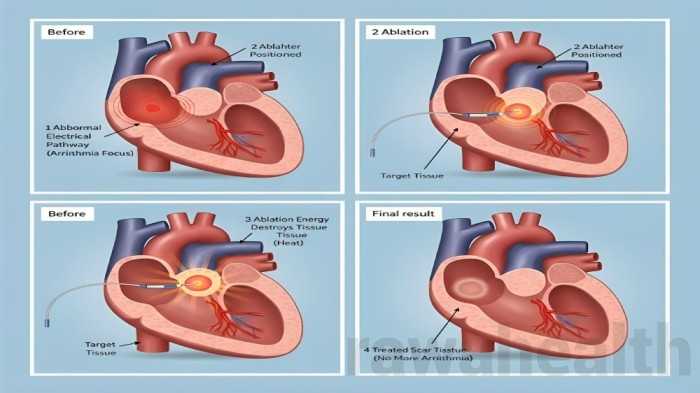 Ablation Surgery in India