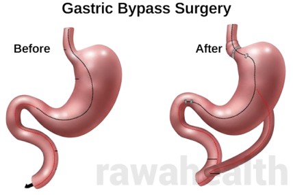 Gastric Bypass Surgery Procedure in India