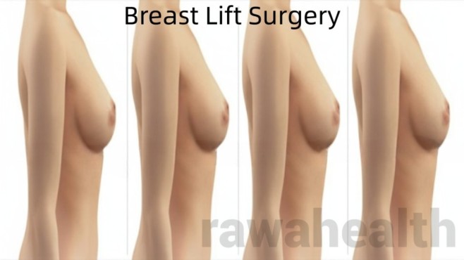 Boob Lift Surgery in India