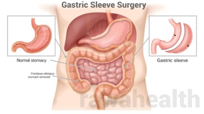Gastric Sleeve