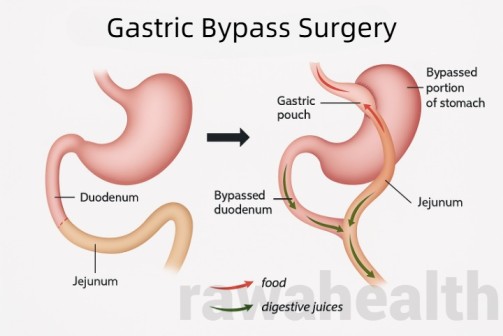 Gastric Bypass Surgery in India