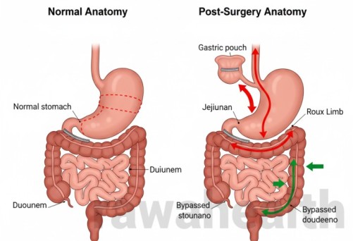 Gastric Bypass Surgery in India