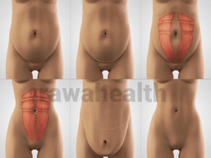 Tummy Tuck Surgery in India