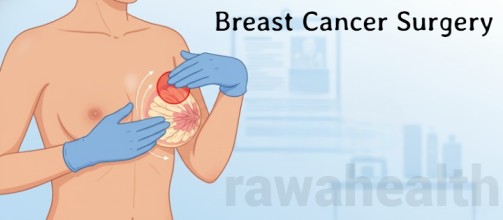 Breast Cancer Surgery in India