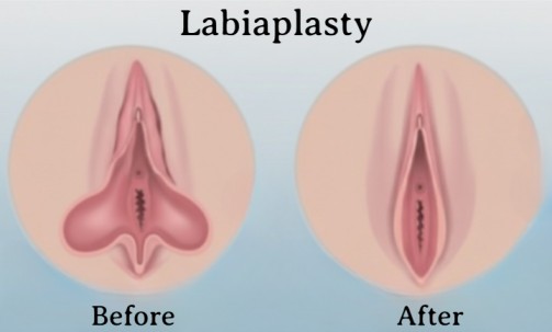 Labiaplasty Surgery in India