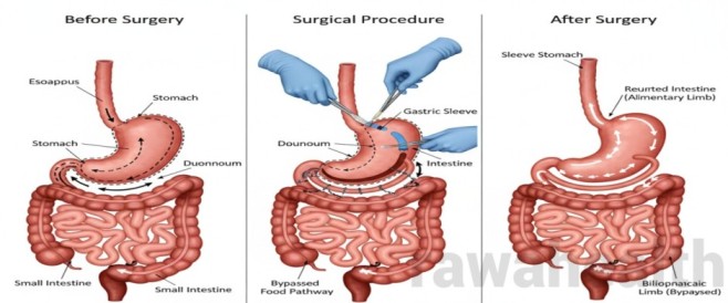 Duodenal Switch Surgery in India