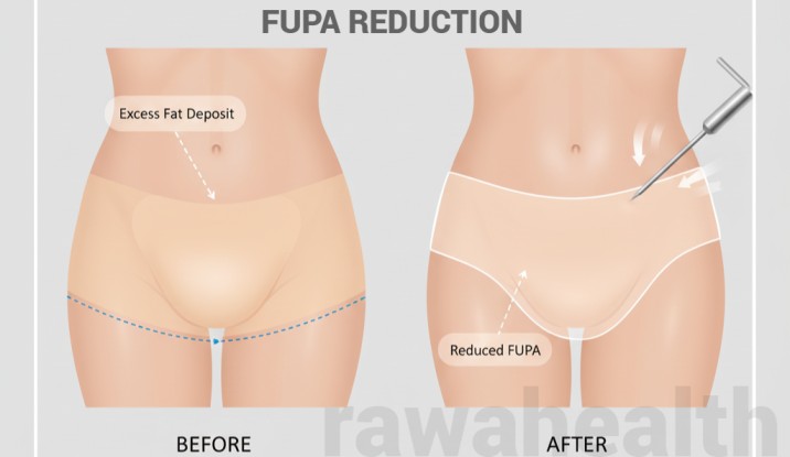 FUPA Surgery in India