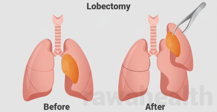 Lobectomy Surgery in India