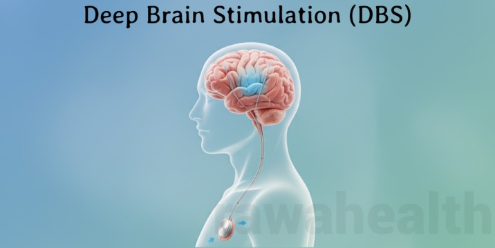 DBS Surgery in India