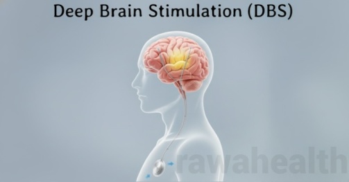 Deep Brain Stimulation Surgery in India