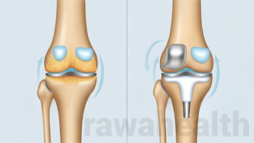 Partial Knee Replacement Surgery in India