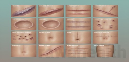 Scar Revision Surgery in India