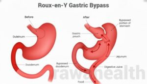 Roux-en-Y Gastric Bypass Surgery in India