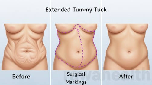 Extended Tummy Tuck in India